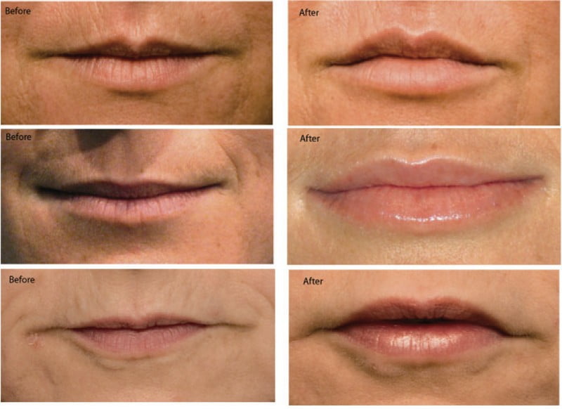 JUVÉDERM Elite Body & Laser Center