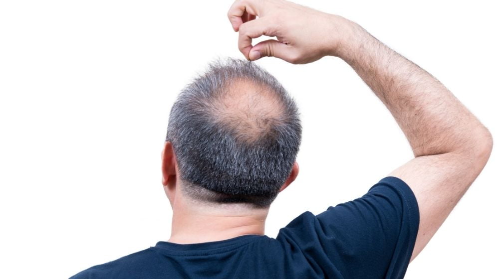 a bald man is picking his hair | Feature | How Balding Patients Fight Hair Loss With PRP Therapy